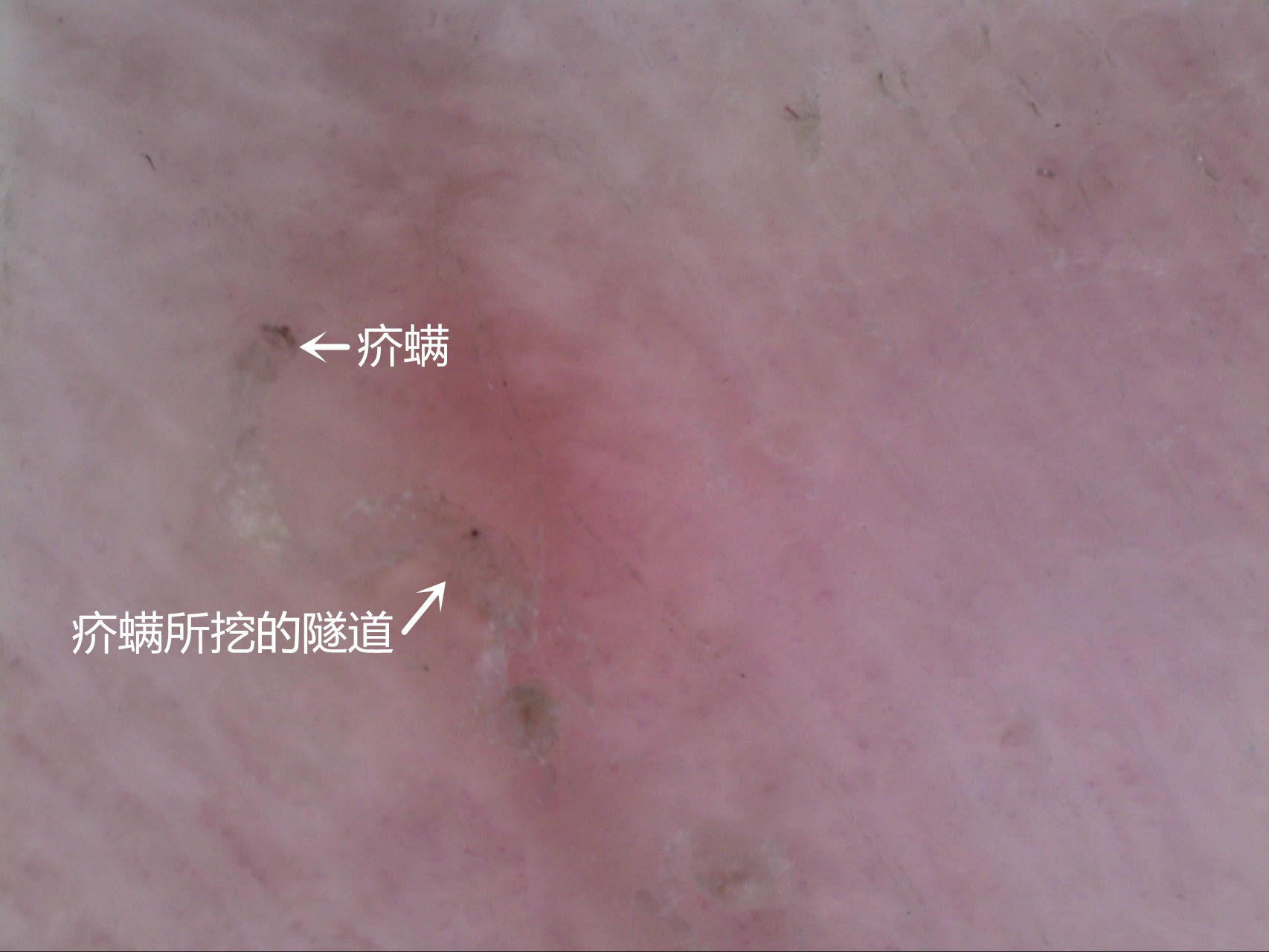 好的疥螨_副本.jpg