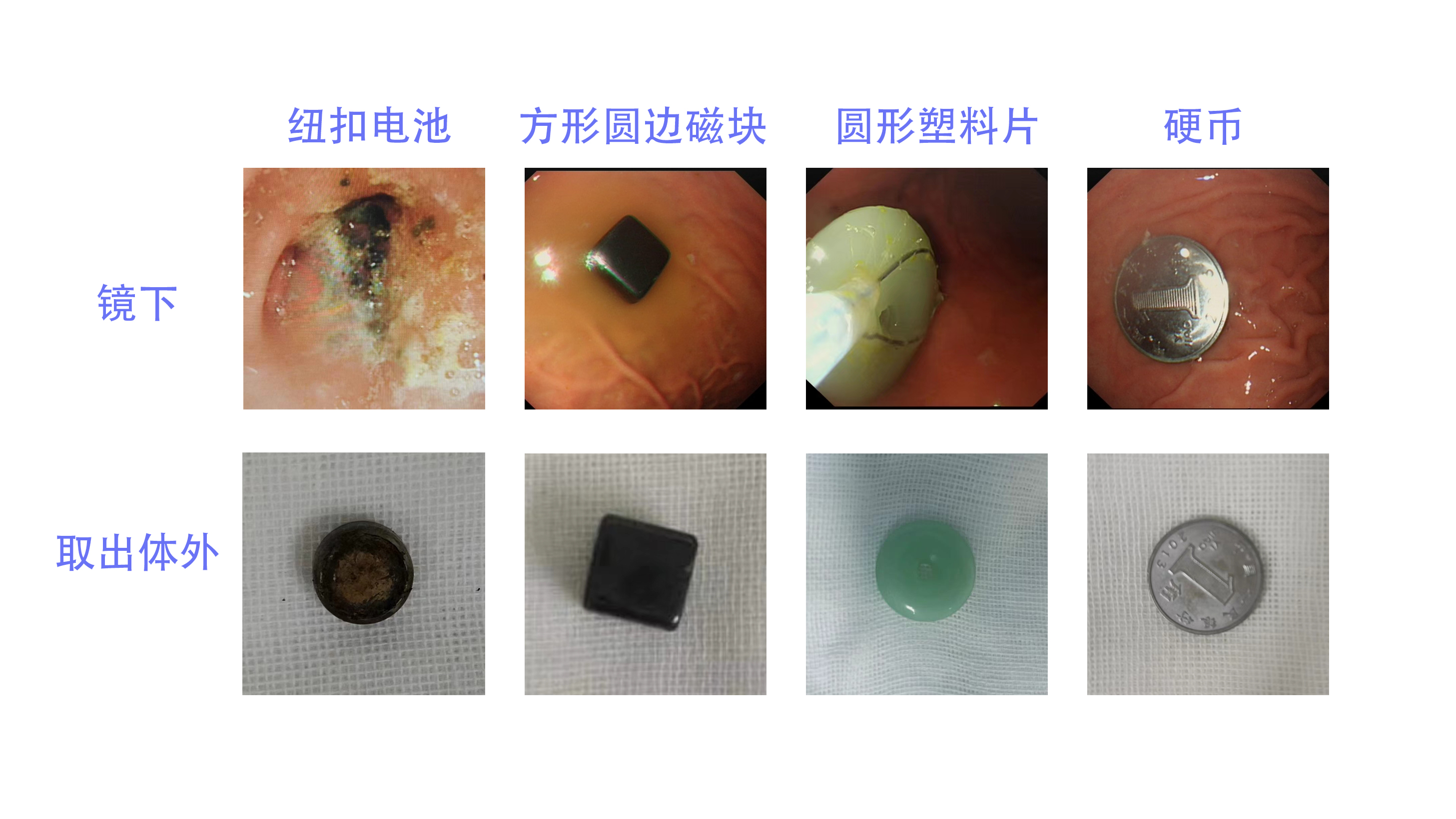 消化道异物.jpg